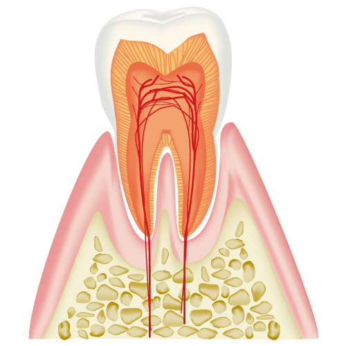エナメル質内のむし歯