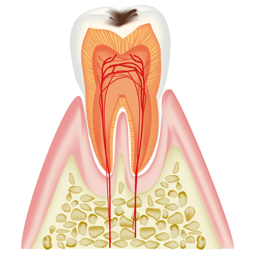 エナメル質内のむし歯