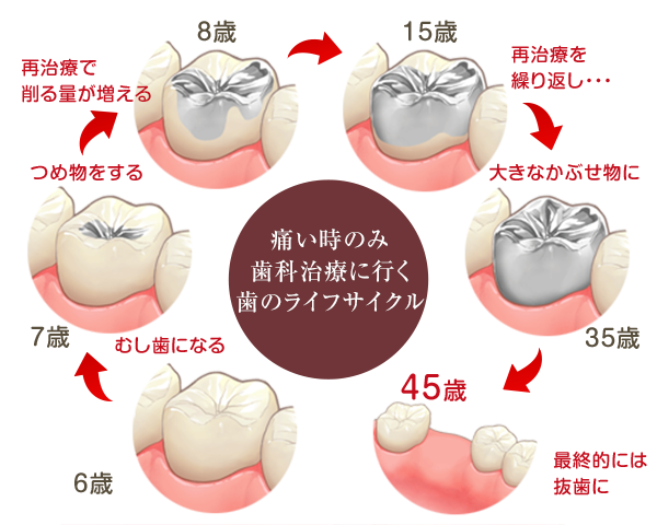 痛い時のみ歯科治療に行く歯のライフサイクル
